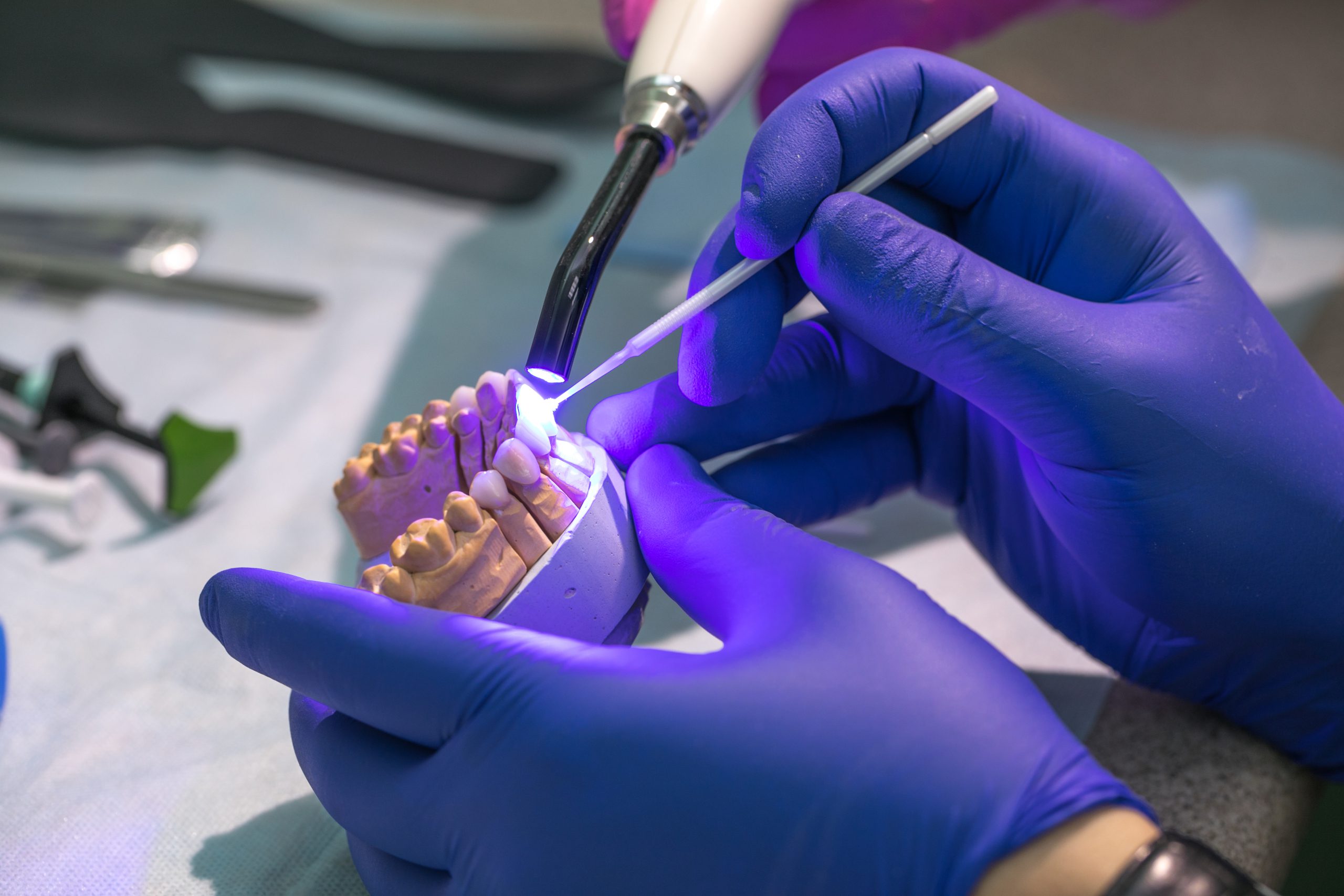Qué son las carillas dentales y para qué sirven