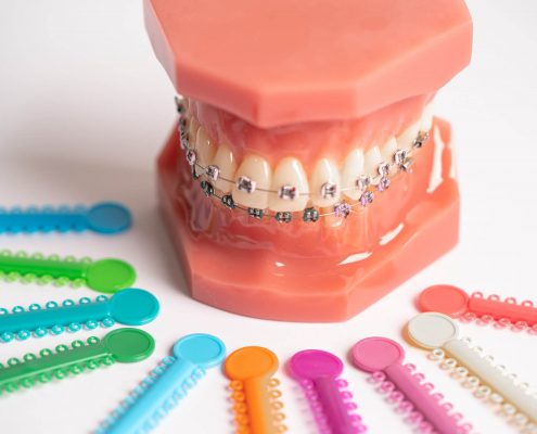 hábitos que debes cuidar si llevas ortodoncia