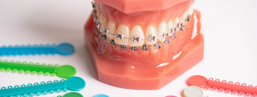 hábitos que debes cuidar si llevas ortodoncia