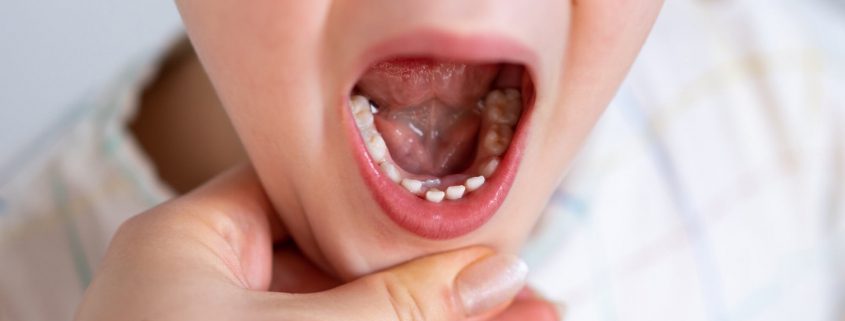 beneficios ortodoncia infantil