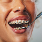 brackets y ortodoncia tradicional