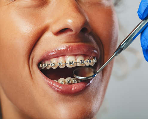 brackets y ortodoncia tradicional