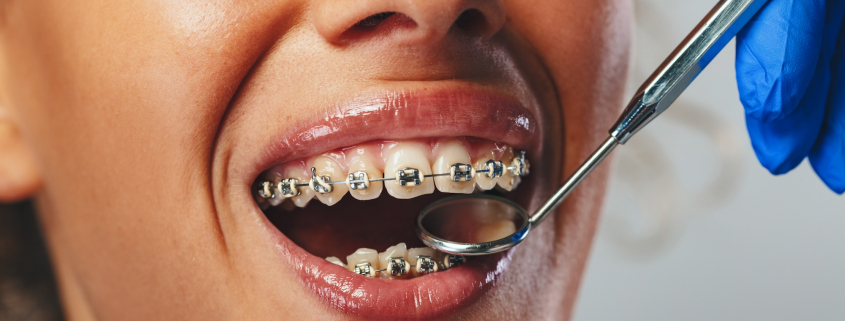 brackets y ortodoncia tradicional