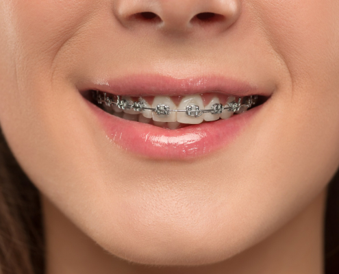 brackets en casos complejos
