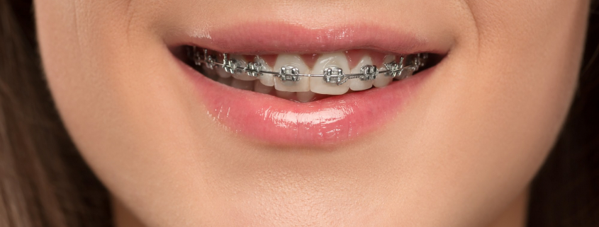 brackets en casos complejos