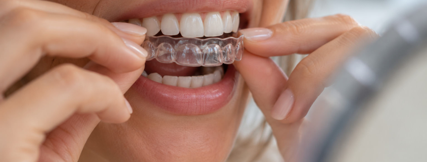 mis dientes se han vuelto a mover